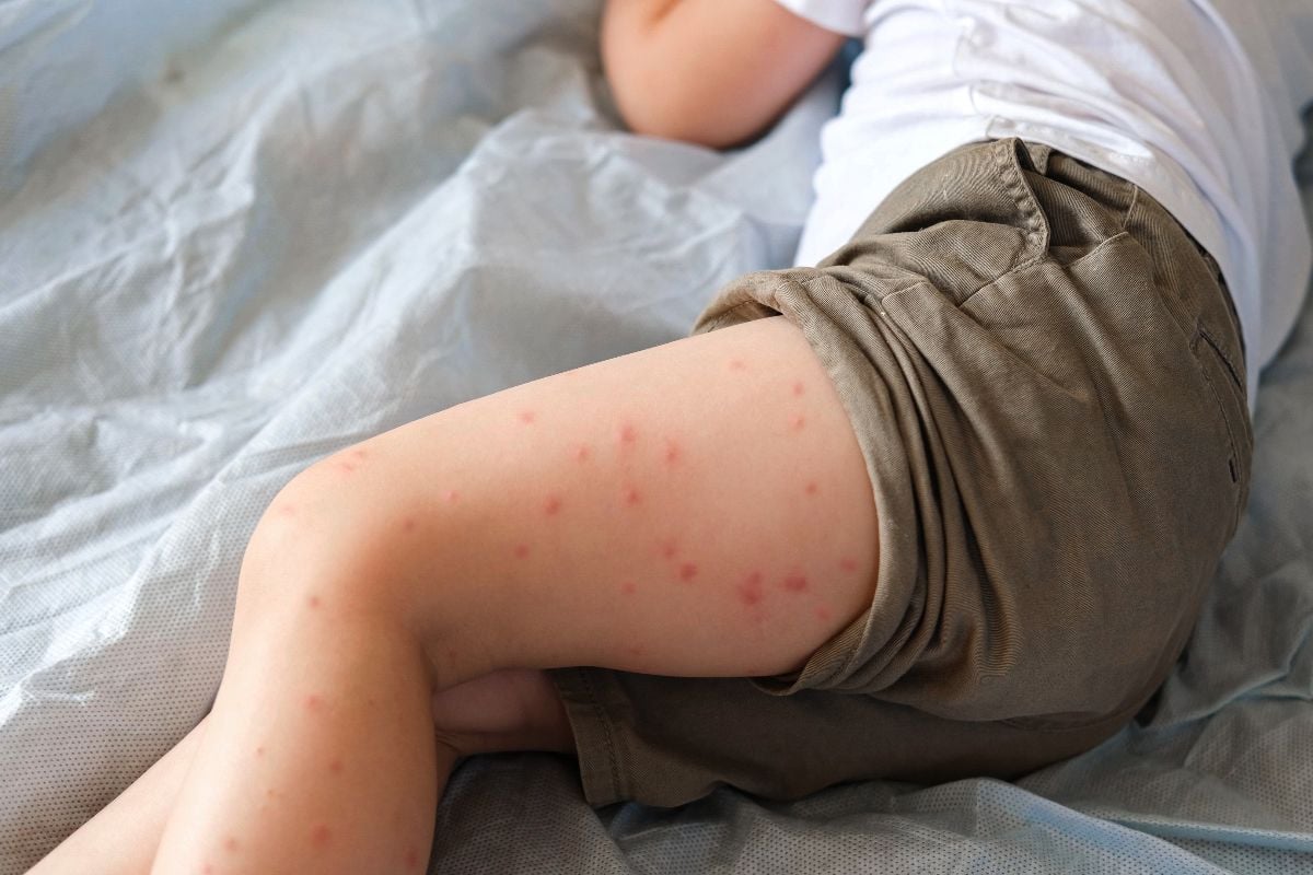 Kid with mosquito bites lying on bed.