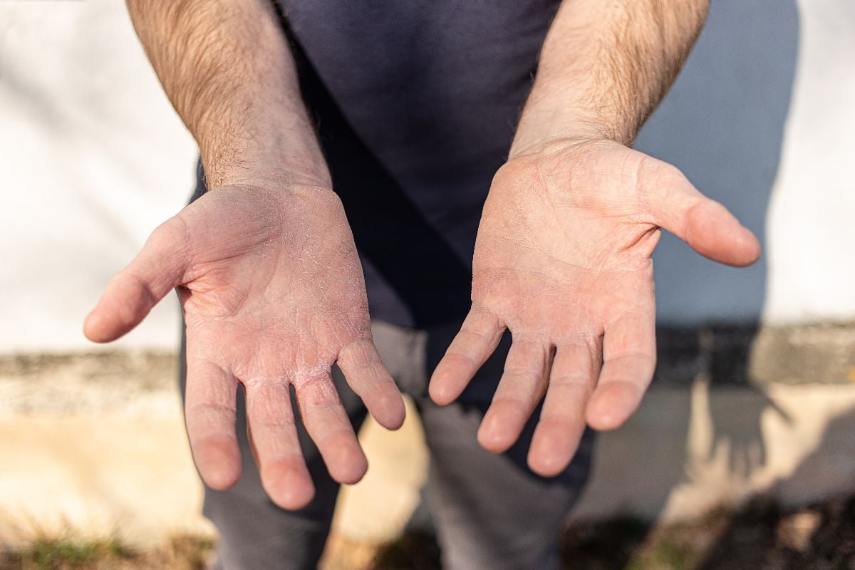 Man showing his dry hands peel.